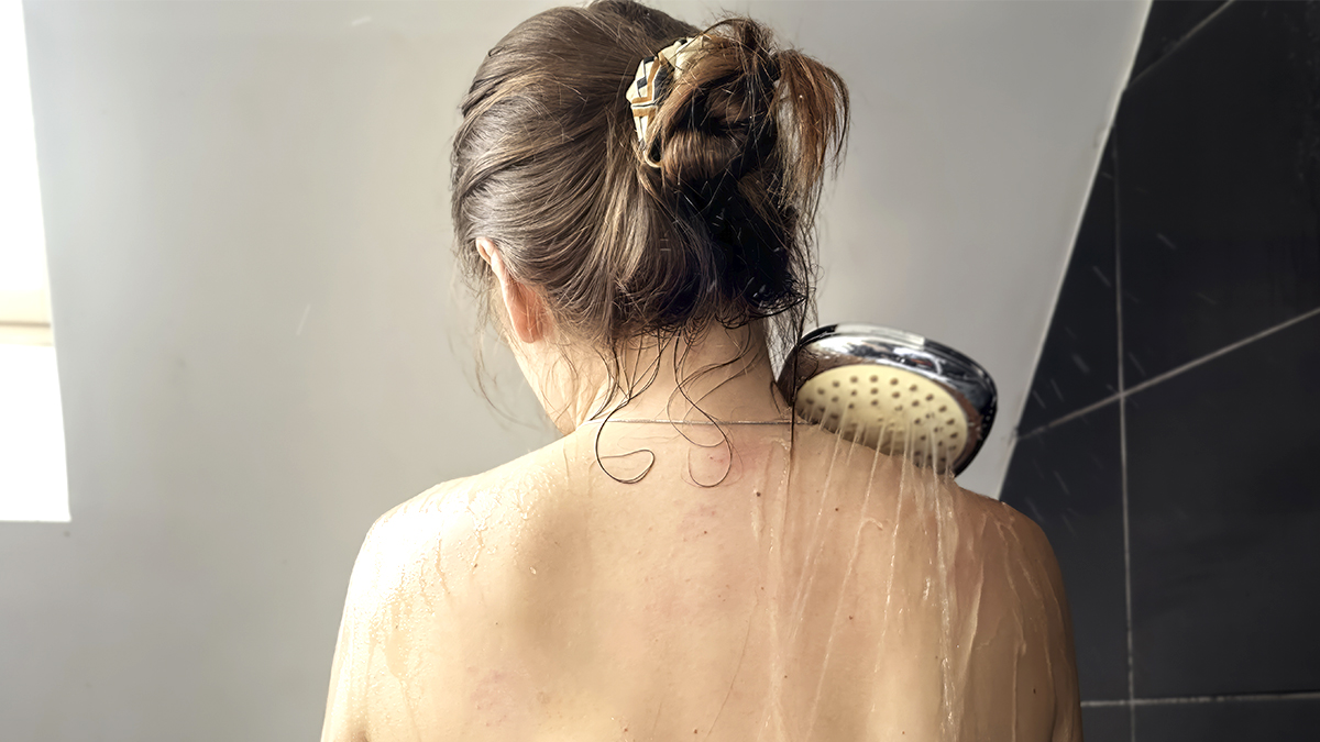 Gros plan sur la peau d'une adolescente couverte de plaques rouges inflammatoires et de papules de 1 à 3 centimètres après contact avec l'eau.